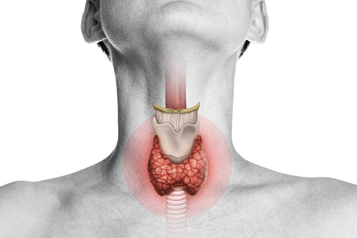 Hypothyroidism: Understanding the Causes, Symptoms, Diagnosis, and Treatment