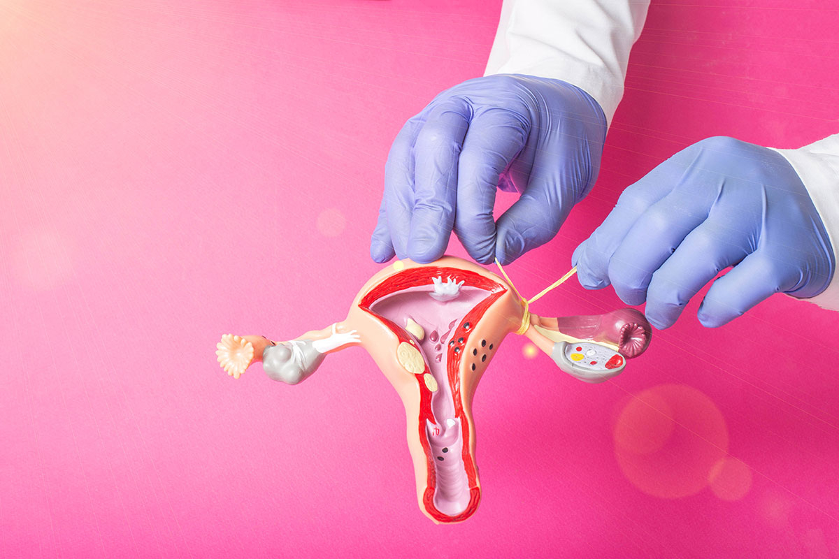 All about tubal ligation