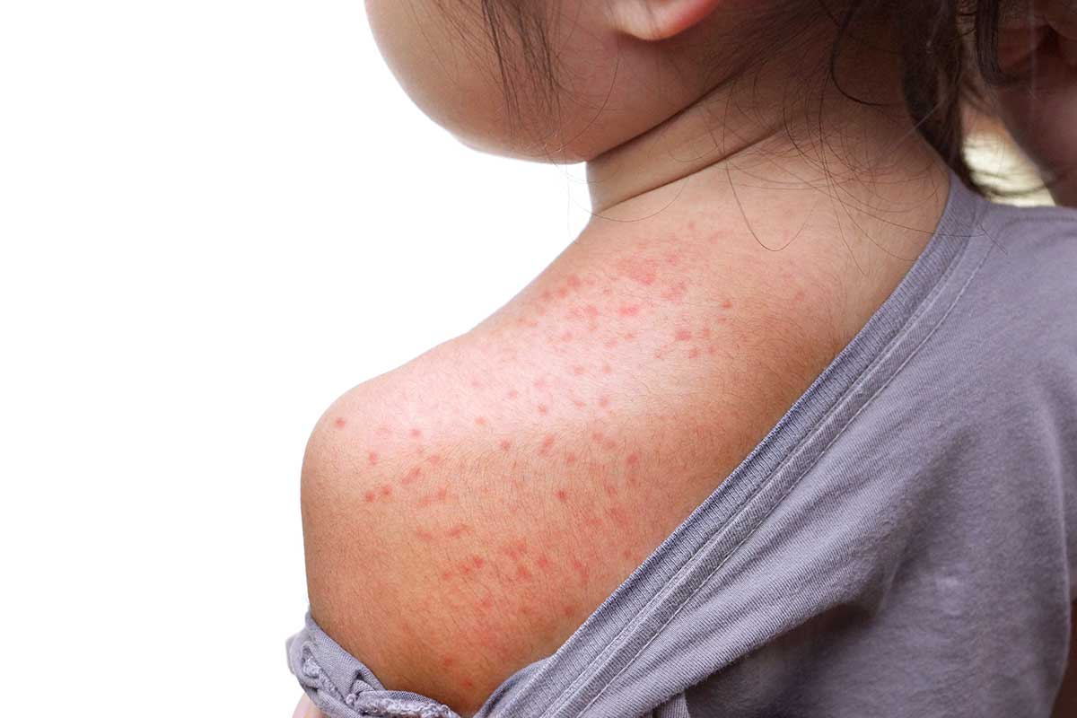 Measles: know the risks of the disease