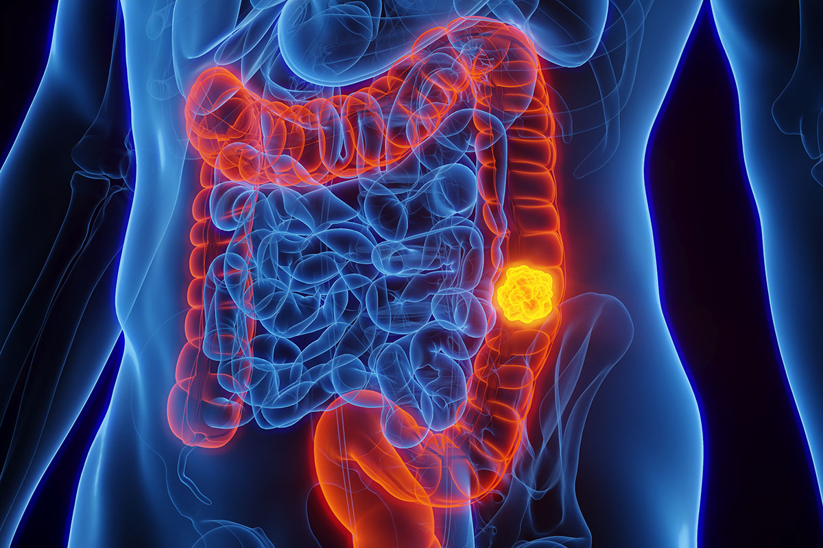 Colon cancer: what it is, main causes and how to identify symptoms