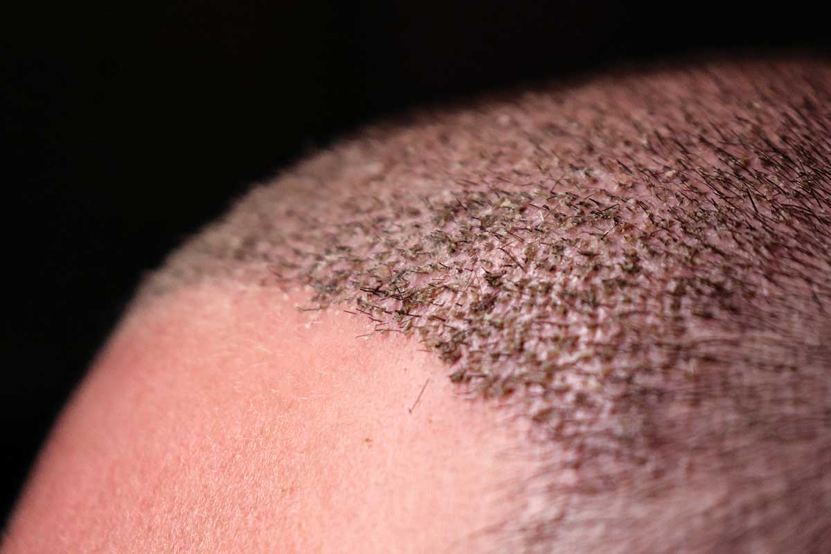 Hair Transplant in Caledon / ON