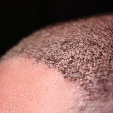 Hair Transplant em Brampton / ON