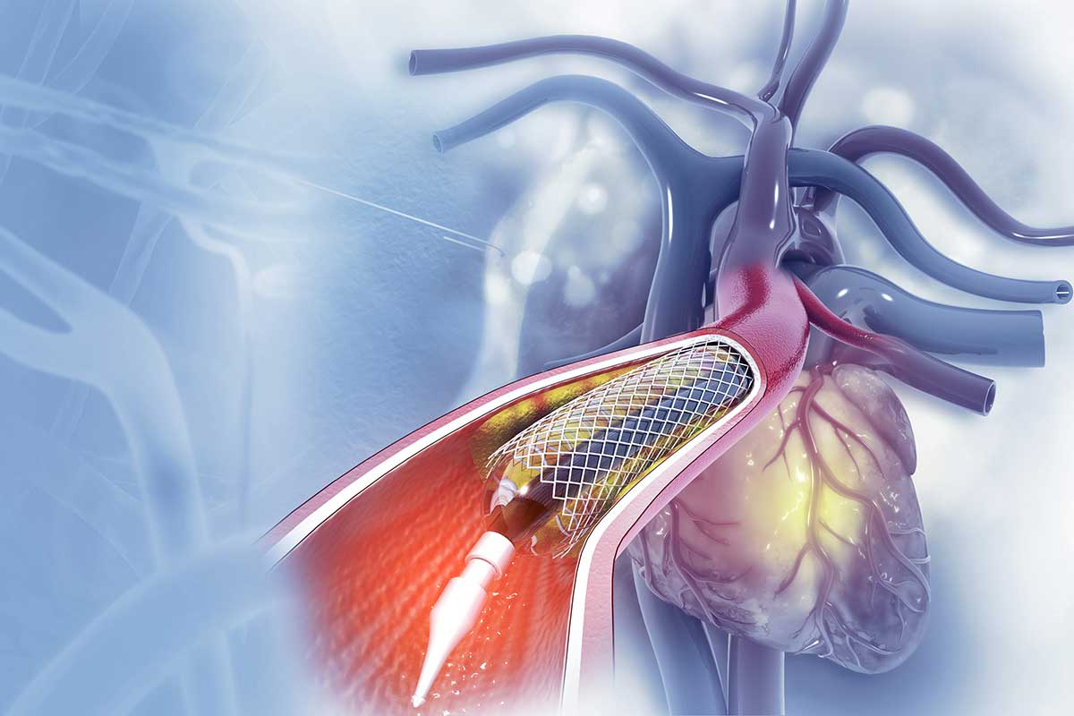 Angioplasty in Surrey / BC