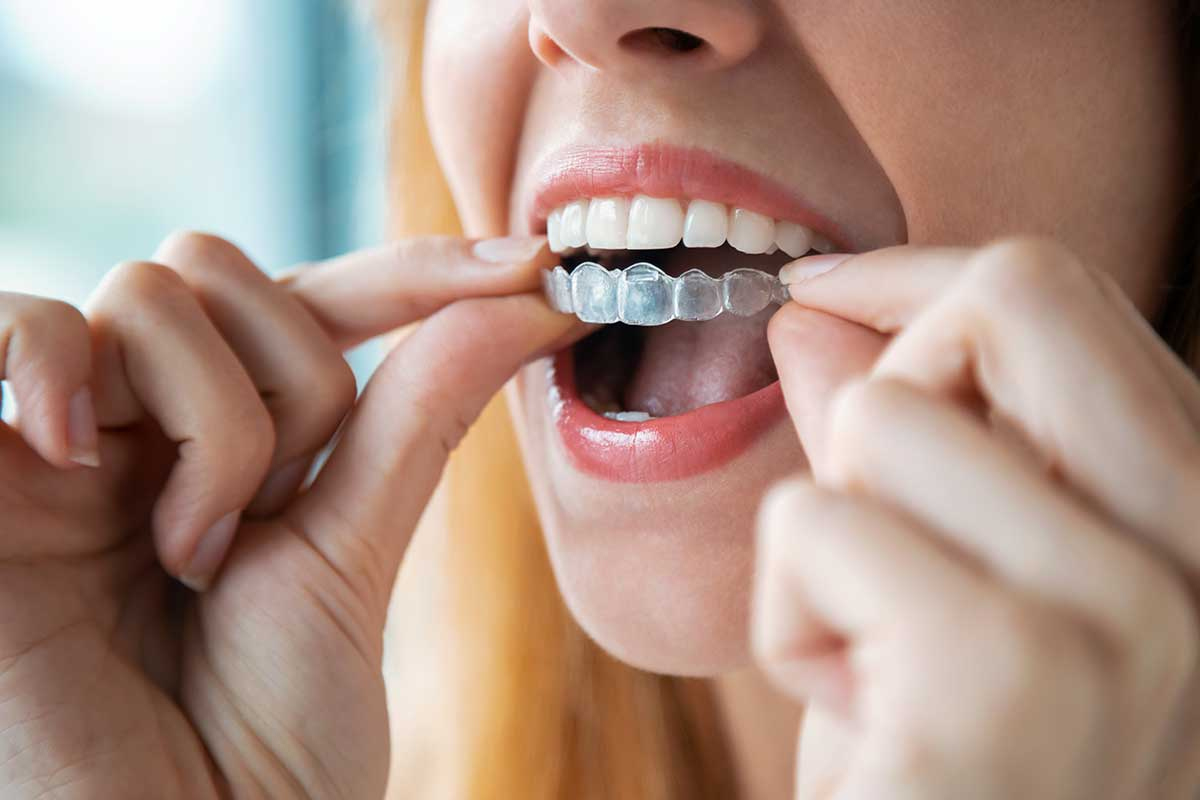 Invisalign in Salaberry-de-Valleyfield / QC